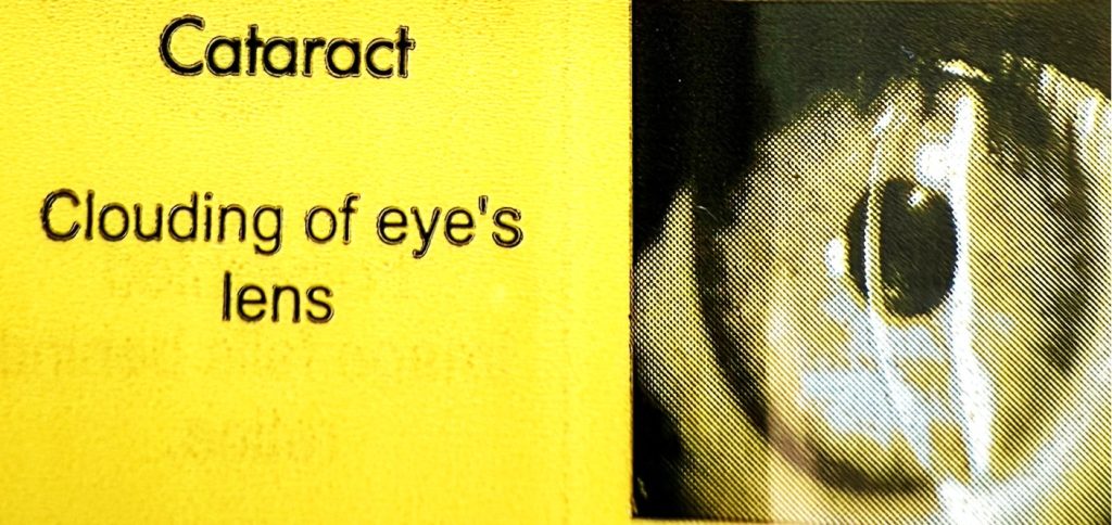 Yellow sign with black text reads Cataract. Clouding of eyes lens next to a close-up image of an eye with visible cloudiness, illustrating the effect of a cataract.