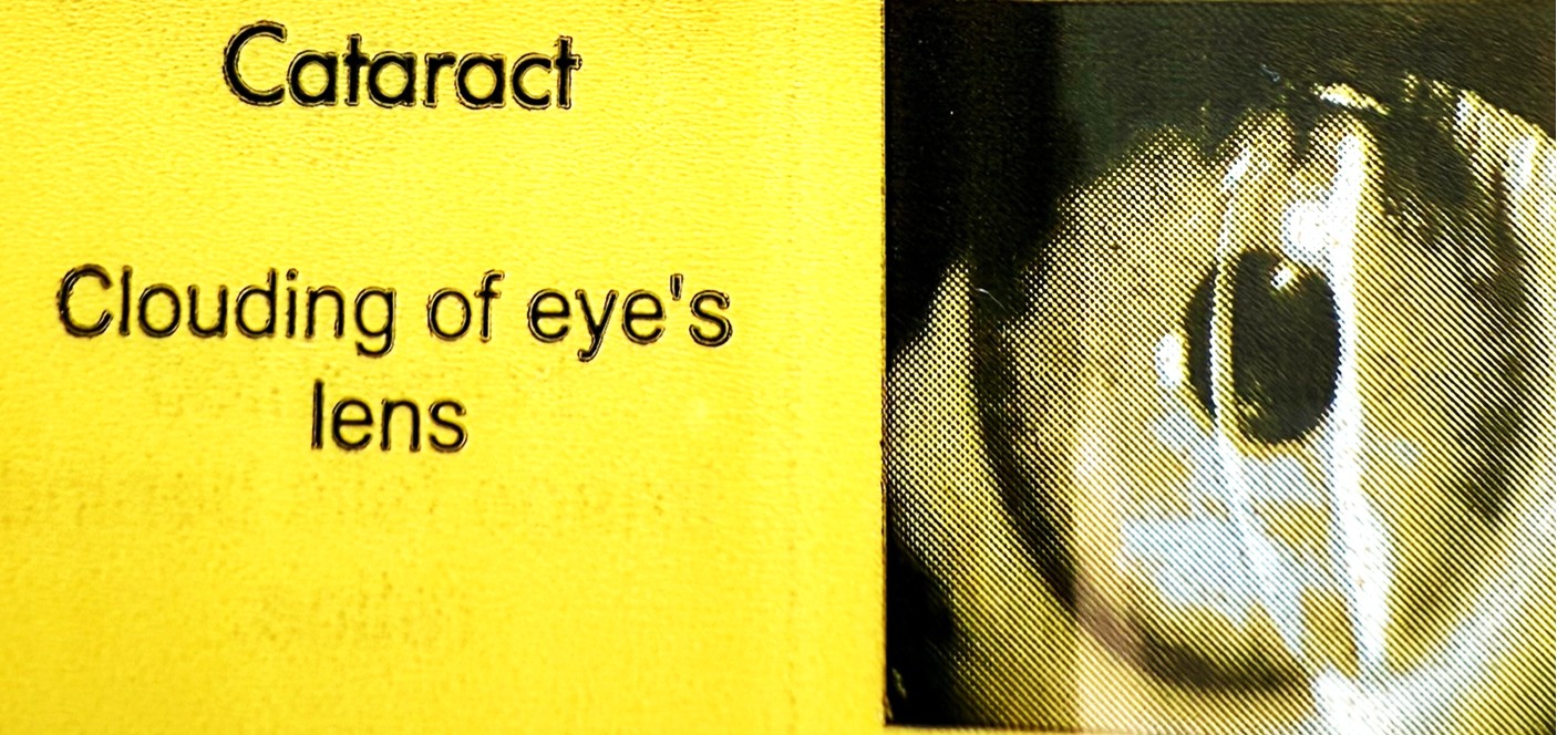 Yellow sign with black text reads Cataract. Clouding of eyes lens next to a close-up image of an eye with visible cloudiness, illustrating the effect of a cataract.